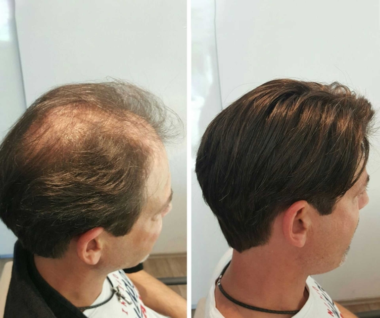 Voher-Nachher-Bild bei einer Haartransplantation eines Mannes mit braunen Haaren