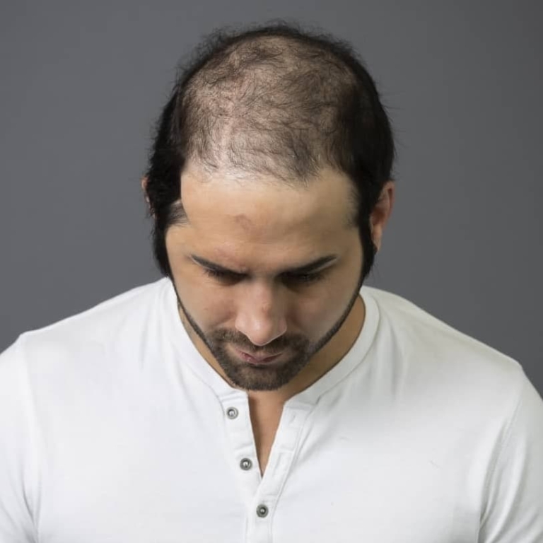 La chute des cheveux chez les hommes